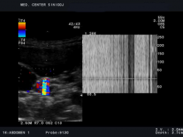 Ultrazvok ledvic - ultrazvočni signal ob ledvičnem kamnu